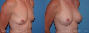 dr-sanders-los-angeles-breast-augmentation_Patient-30-2