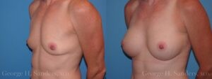 dr-sanders-los-angeles-breast-augmentation_Patient-30-3