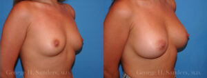 dr-sanders-los-angeles-breast-augmentation_Patient-31-2