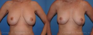 dr-sanders-los-angeles-breast-capsules_Patient-15-1