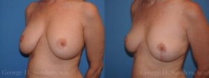 dr-sanders-los-angeles-breast-capsules_Patient-15-3