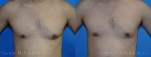 Patient 15a Gynecomastia Before and After