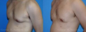 Patient 15b Gynecomastia Before and After