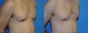 Patient 15c Gynecomastia Before and After