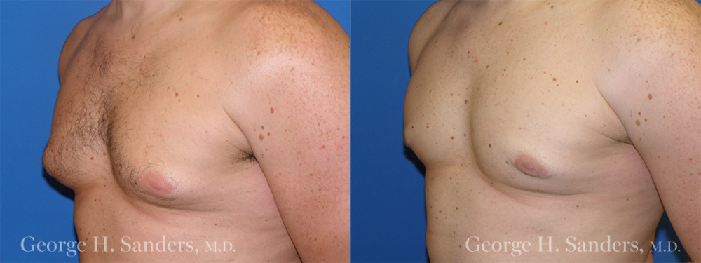 Patient 1b Gynecomastia Before and After