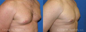 Patient 1c Gynecomastia Before and After