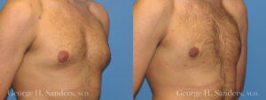 Patient 11b Gynecomastia Before and After