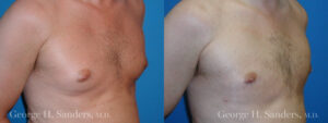 Patient 4c Gynecomastia Before and After