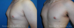 Patient 6b Gynecomastia Before and After