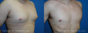 Patient 6c Gynecomastia Before and After