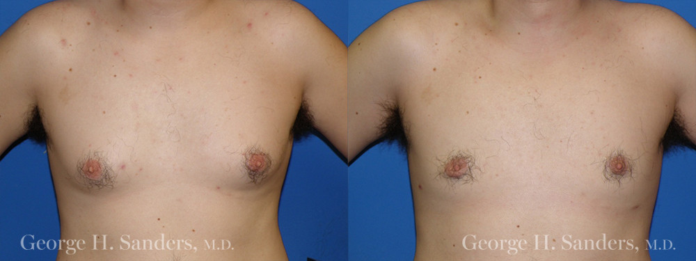 Patient 7a Gynecomastia Before and After