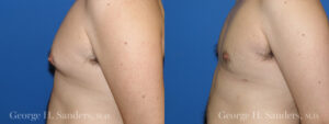 Patient 7c Gynecomastia Before and After
