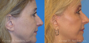 Patient 1b Laserbrasion Before and After