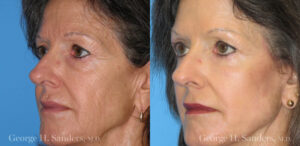 Patient 10b Laserbrasion Before and After