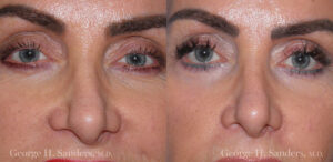 Patient 11a Laserbrasion Before and After