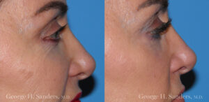 Patient 11b Laserbrasion Before and After