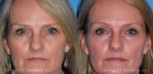 Patient 12a Laserbrasion Before and After
