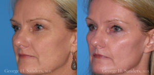 Patient 12b Laserbrasion Before and After