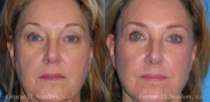 Patient 13a Laserbrasion Before and After