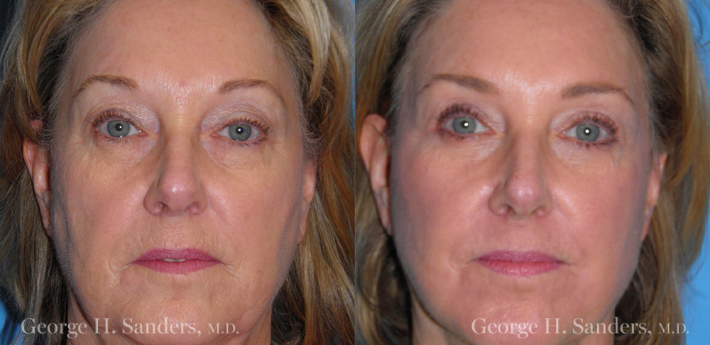 Patient 13a Laserbrasion Before and After