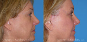 Patient 13b Laserbrasion Before and After