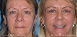 Patient 14a Laserbrasion Before and After