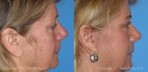 Patient 14b Laserbrasion Before and After