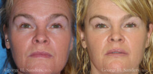 Patient 15a Laserbrasion Before and After