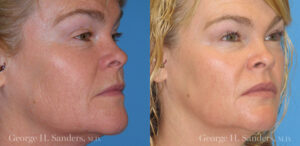 Patient 15b Laserbrasion Before and After