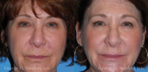 Patient 16a Laserbrasion Before and After