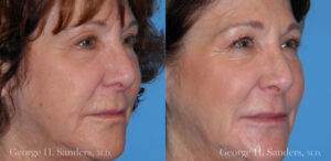 Patient 16b Laserbrasion Before and After
