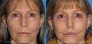 Patient 17a Laserbrasion Before and After