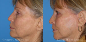 Patient 17b Laserbrasion Before and After