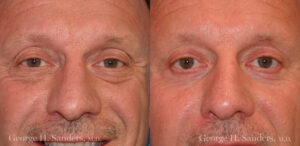 Patient 18a Laserbrasion Before and After