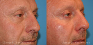 Patient 18b Laserbrasion Before and After