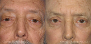 Patient 19a Laserbrasion Before and After