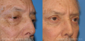 Patient 19b Laserbrasion Before and After