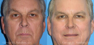 Patient 20a Laserbrasion Before and After