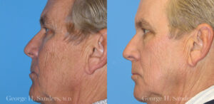 Patient 20b Laserbrasion Before and After