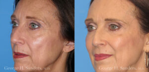 Patient 4b Laserbrasion Before and After
