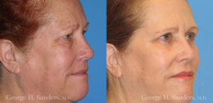 Patient 6b Laserbrasion Before and After