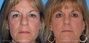 Patient 7a Laserbrasion Before and After