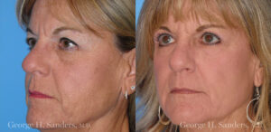 Patient 7b Laserbrasion Before and After