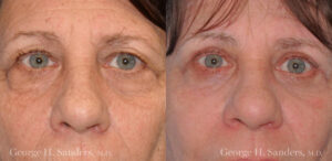 Patient 8a Laserbrasion Before and After