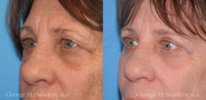 Patient 8b Laserbrasion Before and After