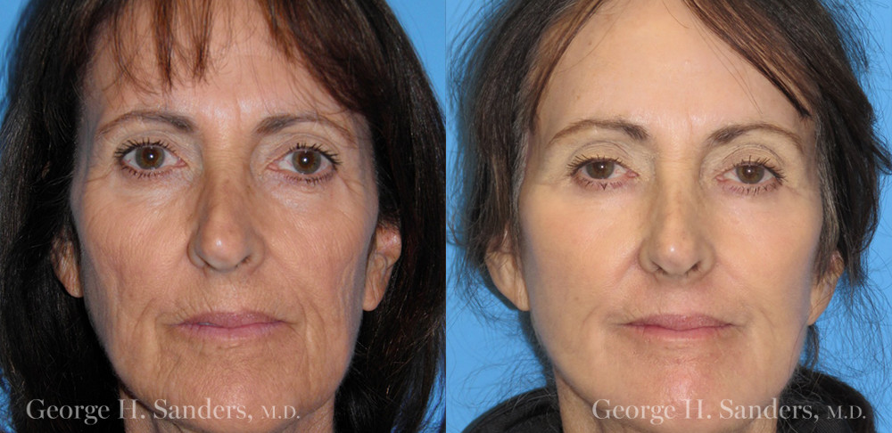 Patient 9a Laserbrasion Before and After