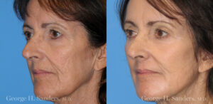 Patient 9b Laserbrasion Before and After
