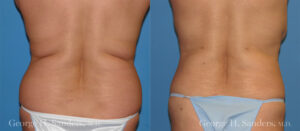Patient 1c Liposuction Before and After