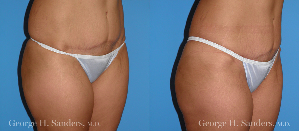 Patient 2b Liposuction Before and After
