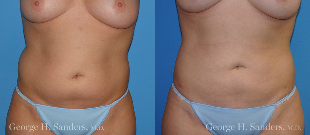 Patient 3a Liposuction Before and After